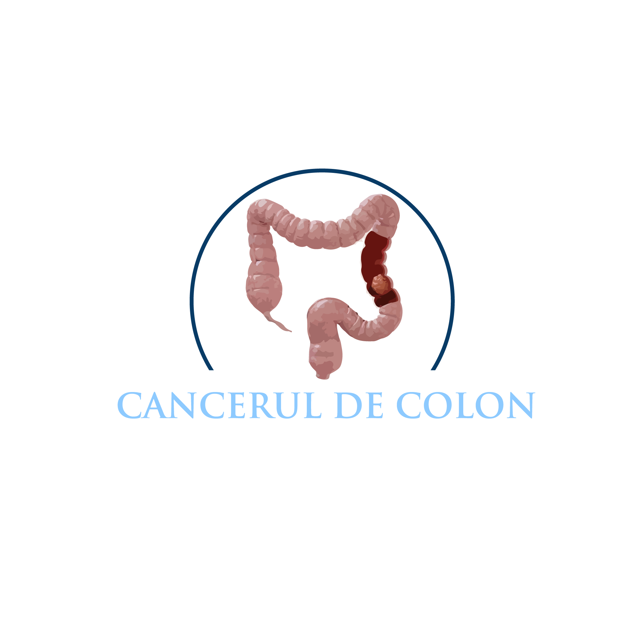 Cancerul de colon - blog